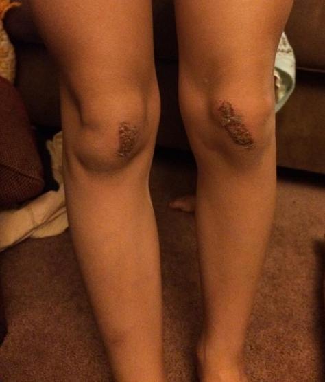 Tala's Scraped Knees